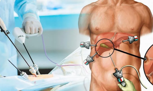 Gallbladder Surgery
