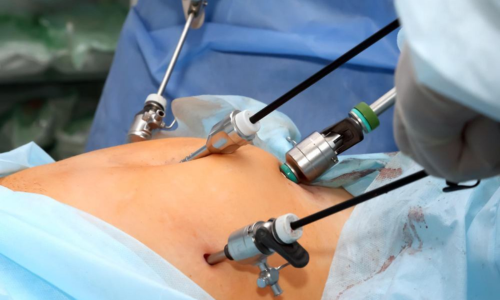 Appendix Surgery